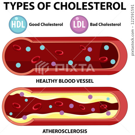 Understanding Cholesterol and Blood Vessels Understanding Cholesterol and Blood Vessels 122591591
