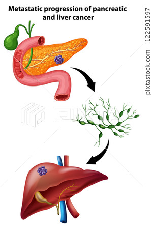 Metastatic Progression of Pancreatic Cancer 122591597