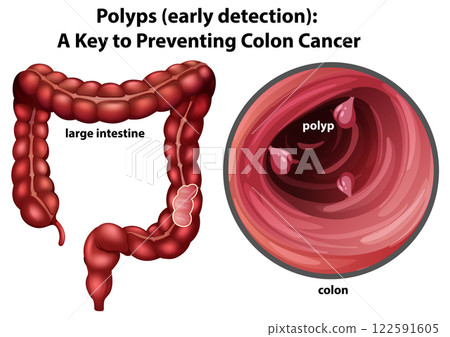 Early Detection of Colon Polyps 122591605