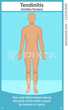 Achilles Tendonitis Illustration 122591608