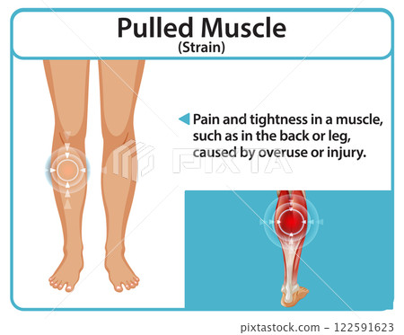 Understanding Muscle Strain and Recovery Understanding Muscle Strain and Recovery 122591623