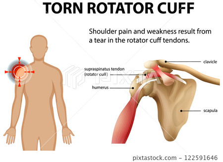 Understanding Torn Rotator Cuff Injuries 122591646