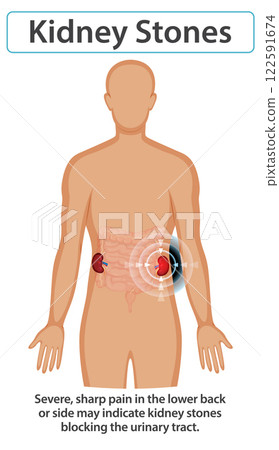Understanding Kidney Stones and Symptoms 122591674