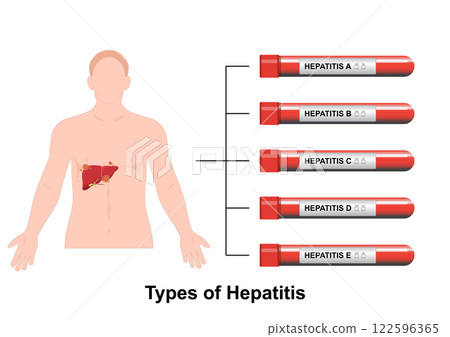 Five viruses that cause the different forms of viral hepatitis. Five viruses that cause the different forms of viral hepatitis. 122596365