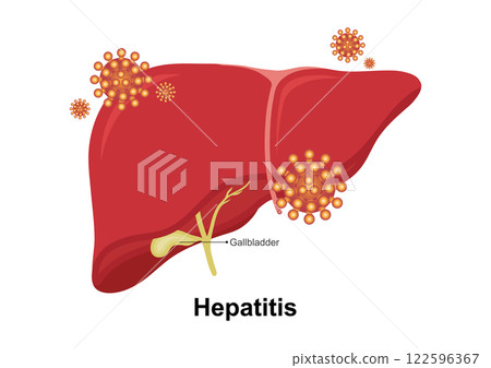 Hepatitis is an inflammation of the liver. Hepatitis is an inflammation of the liver. 122596367