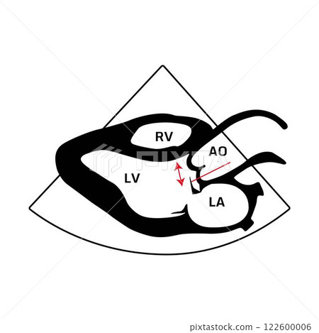 ejection fraction, heart disease 122600006