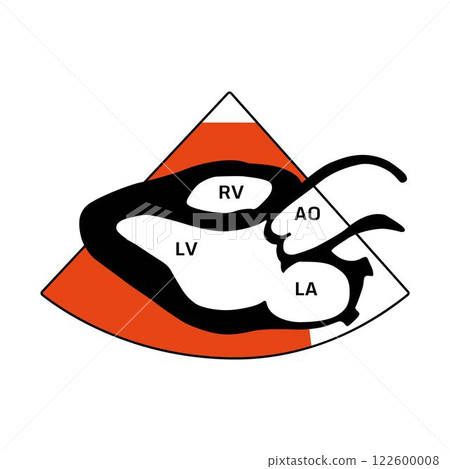 effusion, heart disease 122600008
