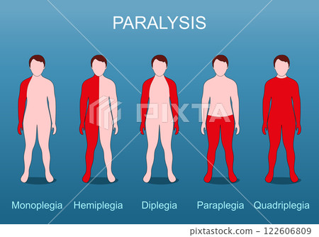 Paralysis. quadriplegia, paraplegia, hemiplegia, monoplegia, and diplegia. 122606809