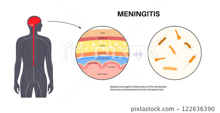 Meningitis medical poster 122636390