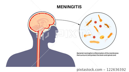Meningitis medical poster Meningitis medical poster 122636392