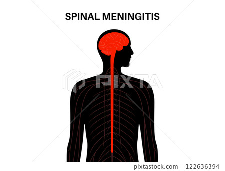 Spinal meningitis poster Spinal meningitis poster 122636394