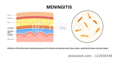 Meningitis medical poster 122636398