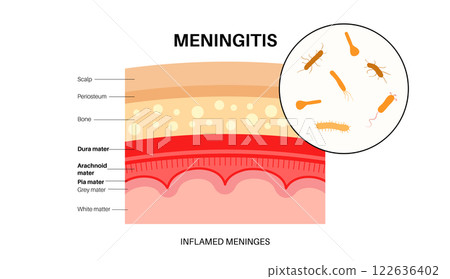 Meningitis medical poster 122636402