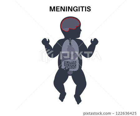 Meningitis medical poster 122636425