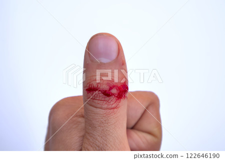 Bloody Thumb Injury, Close-Up Cut Wound with Fresh Blood on White Background 122646190