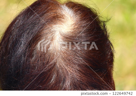 Thinning hair woman hair 122649742