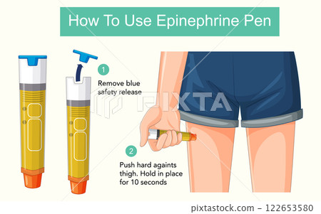 Guide to Using an Epinephrine Pen Guide to Using an Epinephrine Pen 122653580