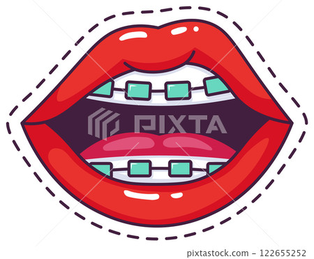 Cartoon illustration featuring vibrant red female lips adorned with braces and a visible tongue, highlighting the importance of dental care and orthodontic treatment for oral health 122655252