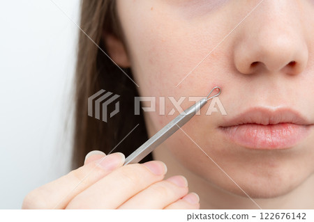 Young woman popping a pimple on a cheek with pimple removal tool. Comedones extractor. Inflamed acne and post-acne marks, redness. Hormonal acne treatment, puberty, adult acne, rosacea. Young woman popping a pimple on a cheek with pimple removal tool. Comedones extractor. Inflamed acne and post-acne marks, redness. Hormonal acne treatment, puberty, adult acne, rosacea. 122676142