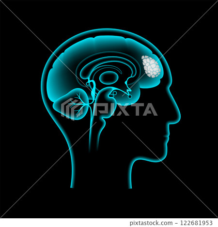 Brain cancer poster 122681953