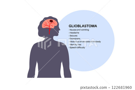 Glioblastoma brain cancer 122681960