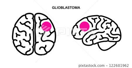 Glioblastoma brain cancer Glioblastoma brain cancer 122681962