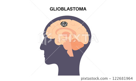 Glioblastoma brain cancer 122681964