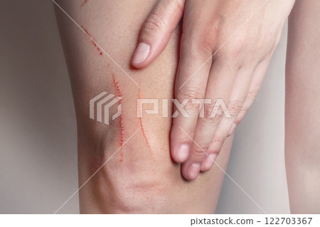 Scratches on the woman's leg. Scratches from cat, dog, beast, falls close up 122703367