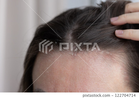 Closeup dandruff flakes on the scalp and on the hair. Closeup dandruff flakes on the scalp and on the hair. 122704714