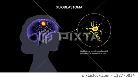 Glioblastoma brain cancer Glioblastoma brain cancer 122770834