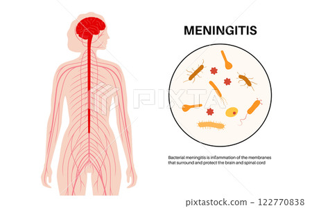 Meningitis medical poster 122770838