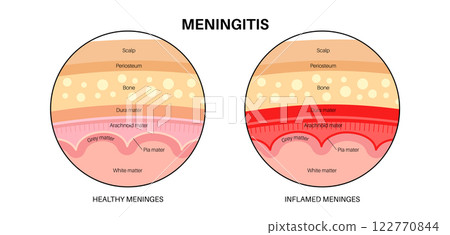 Meningitis medical poster Meningitis medical poster 122770844