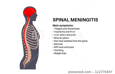 Spinal meningitis poster Spinal meningitis poster 122770847