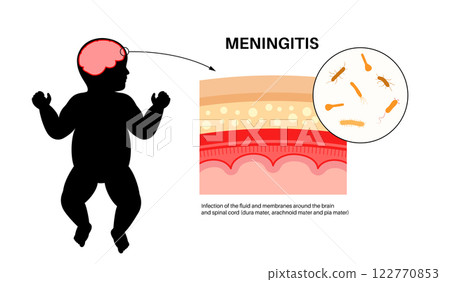 Meningitis medical poster 122770853