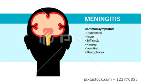 Meningitis medical poster Meningitis medical poster 122770855