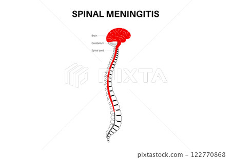 Spinal meningitis poster Spinal meningitis poster 122770868