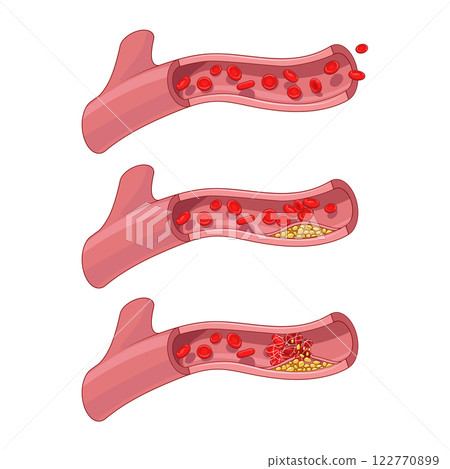 Blood vessel and clot thrombus vector illustration 122770899