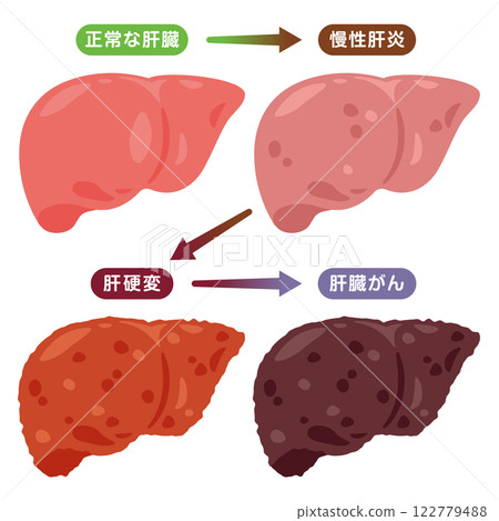Illustration of the process of developing liver cancer 122779488