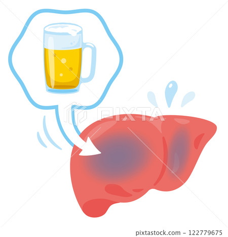 Illustration of liver damaged by alcohol 122779675