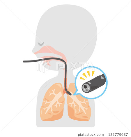 A simple profile illustration of a person undergoing a bronchoscopy 122779687