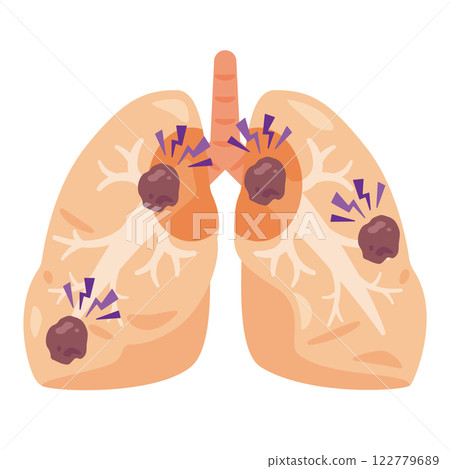肺癌肺部圖示 2 122779689