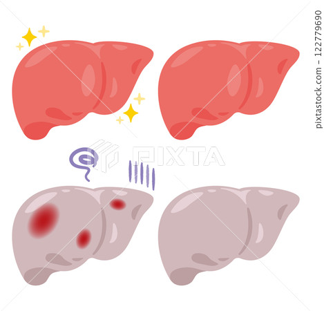Illustration of a healthy and clean liver and an inflamed unhealthy liver 122779690