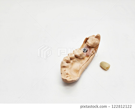 Implant Zirconia Crown 122812122