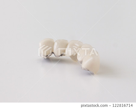 金屬黏合劑、門牙橋、自費治療、牙齒修復材料、不享有保險、背部 122816714