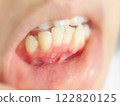 Mouth ulcers, dental treatment, aphtha cases 122820125