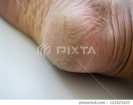 Healing cracked skin foot care home health image natural light close-up wellness 122825203