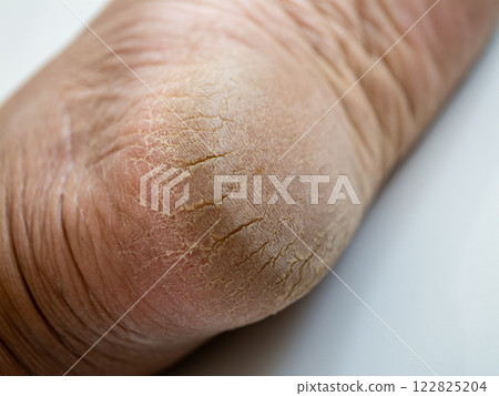 Caring for cracked skin remedies and solutions for dry elbows home care health close-up wellbeing 122825204