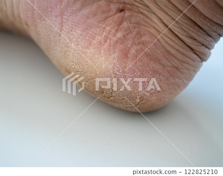 Effective tips and remedies for cracked heels and skin health in your home wellness routine Effective tips and remedies for cracked heels and skin health in your home wellness routine 122825210