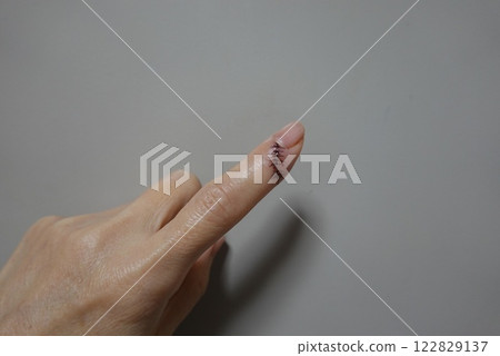 左手食指受傷,縫合,第一天 左手食指受傷,縫合,第一天 122829137