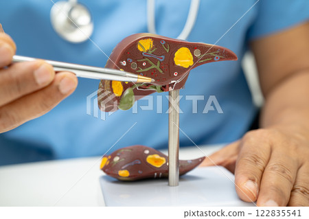 Cirrhosis, Liver cancer, fatty liver, Asian doctor with liver human anatomy model in World Hepatitis Day at hospital. 122835541